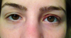Third- revision for overcorrection (removed a suture)