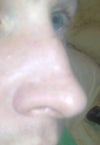 The pre-op nose