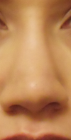 post op 11 months