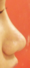 post op 11 months