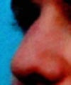 nose 8 weeks after surgery, 3/4 view