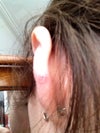 Ear - 1cmx1cm waxy bump with visible blood vessels, this has bled and healed over, only to bleed again. Occassionally itches.