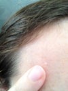 Forehead - waxy bump grown from barely visible (i could only feel it) to nearly 3mm since May2012.