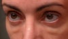 stubborn swelling (not granulomas)