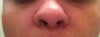 Uneven nostrils