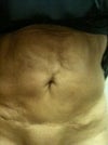 lax skin from a partial reverse abdominoplasty under the left breast only