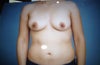 prior to surgery