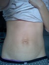Front view. Can see umbilical hernia.