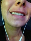 Notice the almost square type of scarring in the lower left chin area.