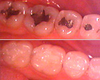 Tooth Repair Before and After Photos