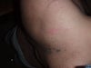 acne scar