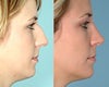 Septoplasty Before and After Photos