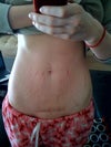 As you can see I have quite a few stretchmarks, (two pregnancies, second was a twin surrogacy for my friend).