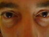 30 year old male tear trough