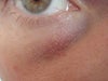 under eye white bumps