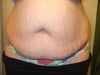 tummy tuck for stretch marks