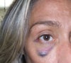 botox hematoma