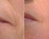 Green Peel Before and After Photos