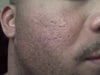 Acne Scars on African American Skin