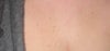 sun damage spots
