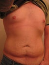ugly stomach after weight loss