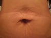 Six weeks ago I had a mini-tummy tuck and hernia repair