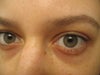 patches under my eyes 