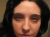 I am 28 years old with eye bags. I am interested in cosmetic procedure options