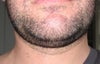 best double chin liposuction technique