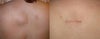 Lipoma Removal Before and After Photos