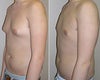 Male Breast Reduction Before and After Photos