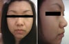 Thick meaty nose surgery