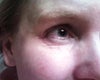 Crepey Under Eye Skin After Retin A?