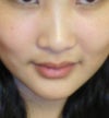 nose implant for asian female