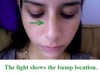 Nose callus