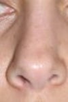 male revision rhinoplasty
