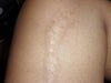 hot wax burn scar
