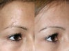 Scar Removal Before and After Photos