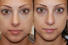 Silikon 1000 Before and After Photos