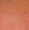 forehead bumps