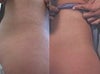 Stretch Marks Treatment Before and After Photos