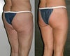 Thigh Lift Before and After Photos