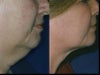 Tumescent Liposuction Before and After Photos
