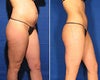 Zerona Before and After Photos