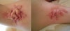 hypertrophic scars from hidradenitis suppurativa