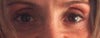 sunken eyes