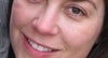 cheek dents