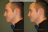 open vs closed rhinoplasty