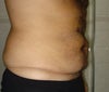 male tummy tuck