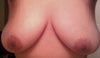 Really want to get a Breast reduction, Breast lift, then get Breast implants